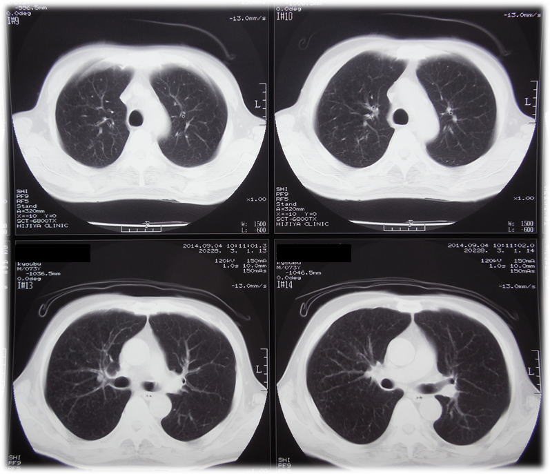 未使用品】 【裁断済み】CTパターンから理解する呼吸器疾患 所見× 